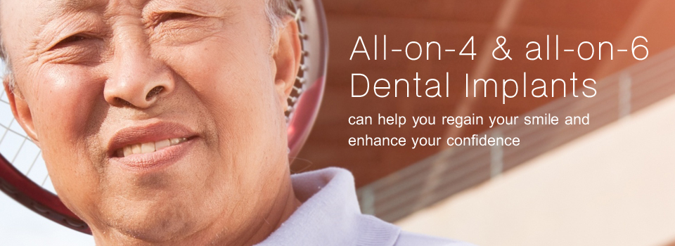 All-on-4 and all-on-6 Dental Implants