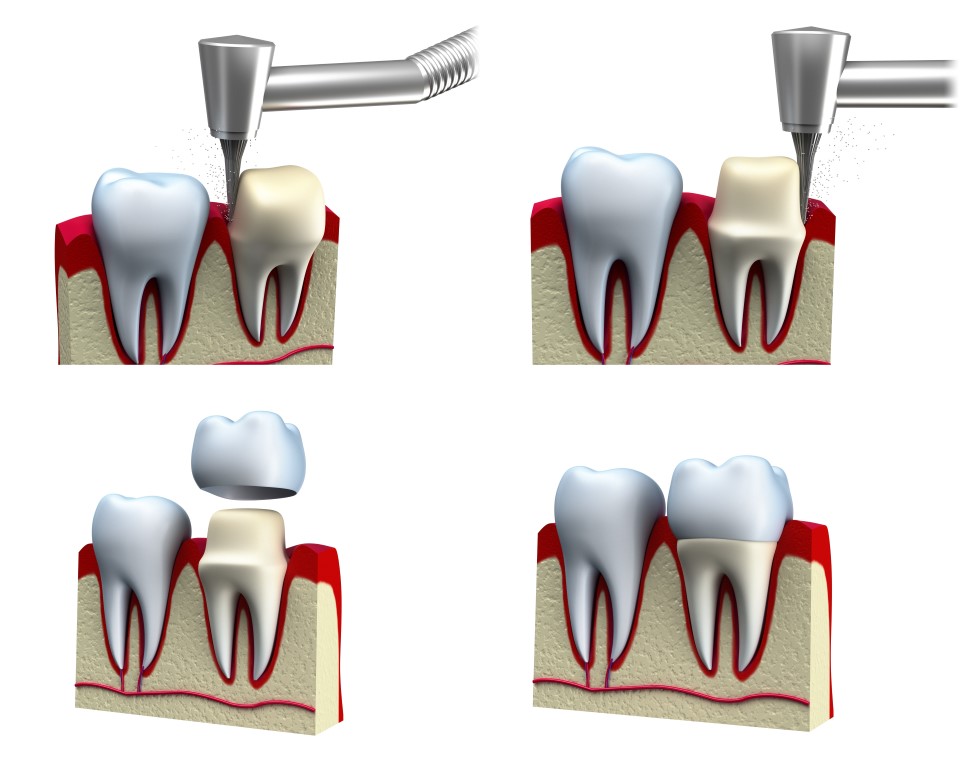 dental crown installation process, isolated on white