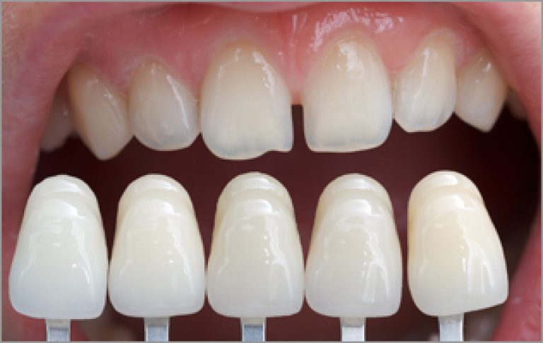 Veneers Phuket Dental Care