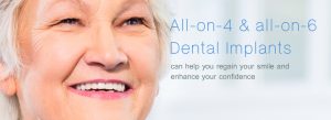 All-on-4 and all-on-6 Dental Implants
